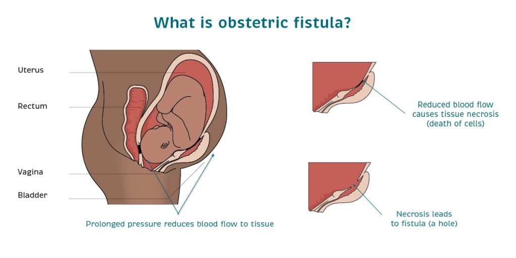 Causes of fistula | Catherine Hamlin Fistula Foundation (USA) | Working to eradicate obstetric fistula. Forever.